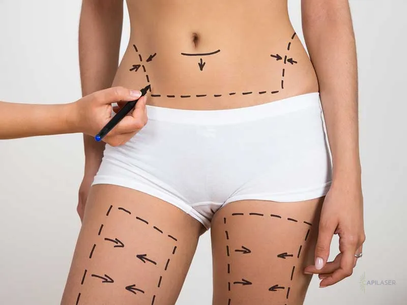 Lipolyse Laser - Smartlipo