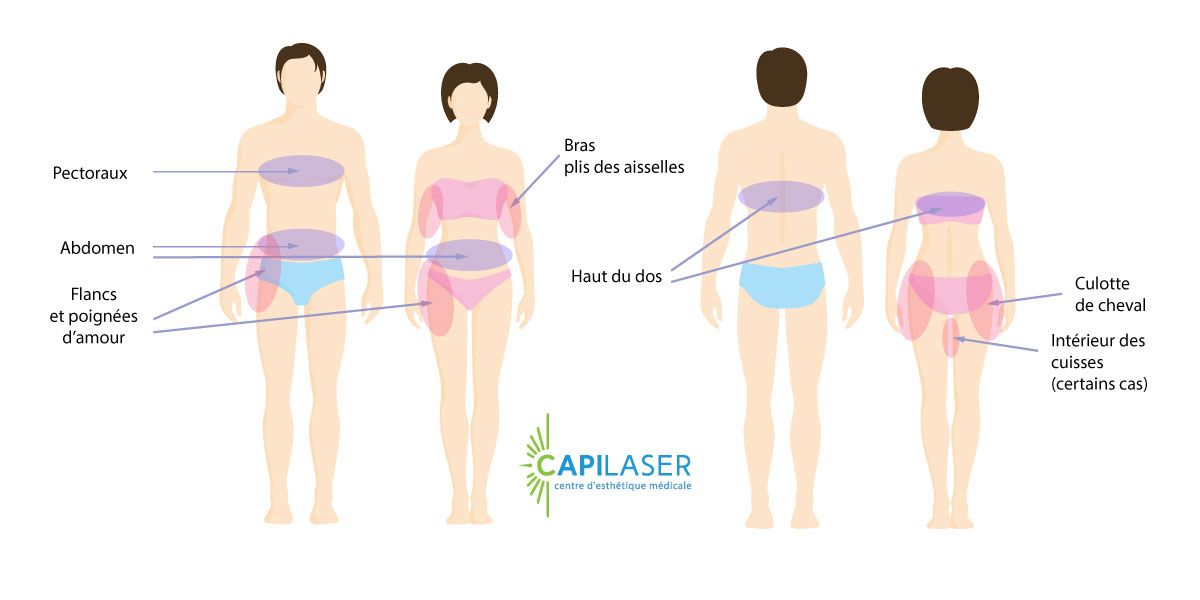 Principales zones d'application de la Cryolipolyse